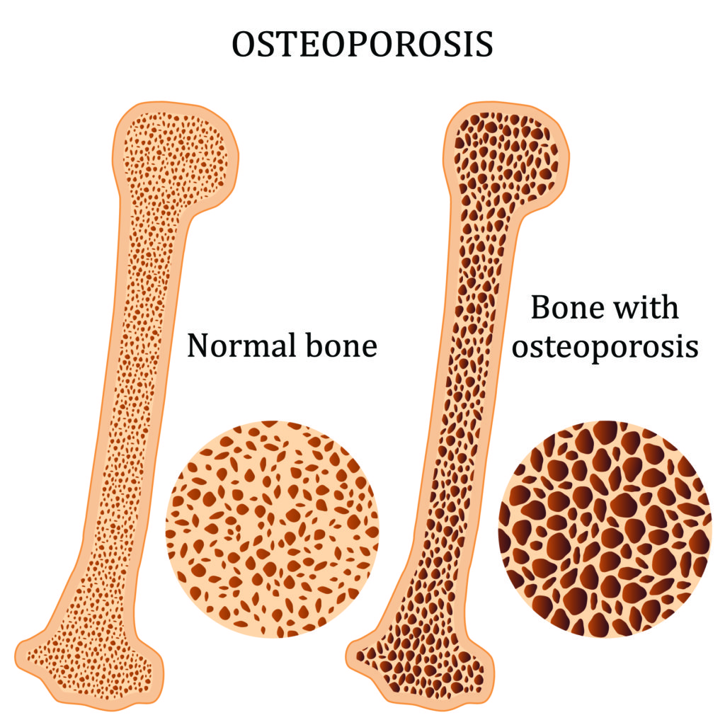 OSTEOPOROSIS AND PH CONNECTION PH FocusedpH Focused